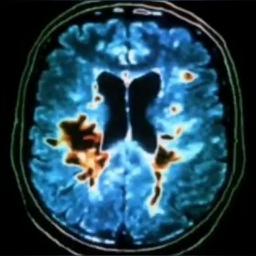 Multiple Sklerose | Neurologie | Medizin | Multiple Sklerose | Neurologie | Medizin